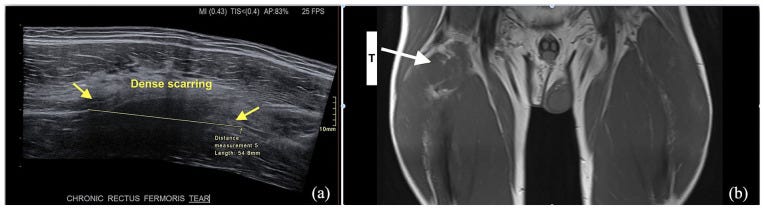 Cadera 1 dolor 5 tempo formacion ecografia.jpg